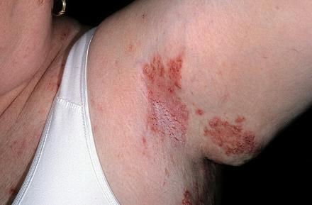 choroba haileya-haileya zdjęcia