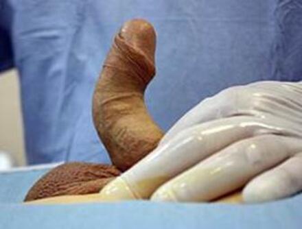 choroba peyroniego zdjęcie