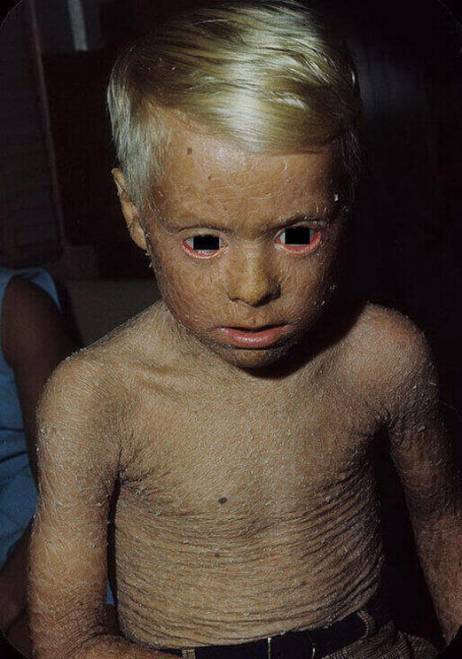 choroba rybia łuska u dziecka