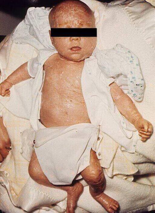 choroba rybia łuska u noworodka