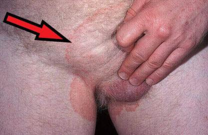 czerwone plamy w pachwinach