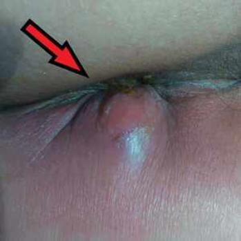 czyrak w miejscu intymnym