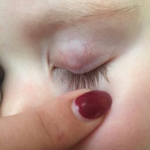 gradówka na powiece u dziecka