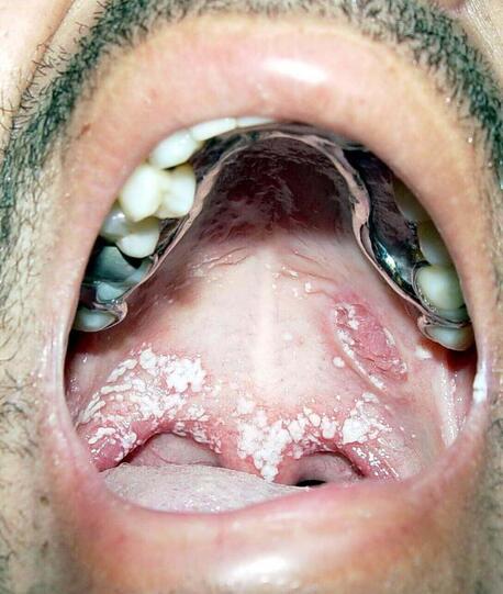 grzybica jamy ustnej 