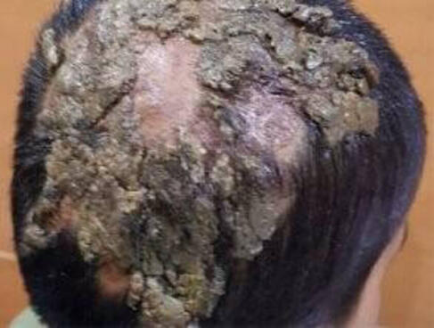 grzybica woszczynowa skóry głowy