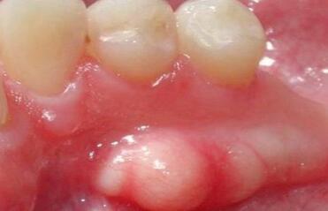 guzek na podniebieniu wyczuwalny językiem