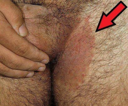 jak wygląda grzybica pachwin