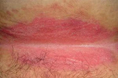 jak wygląda okołoodbytnicze zapalenie skóry