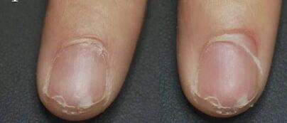Nadmierna kruchość paznokci