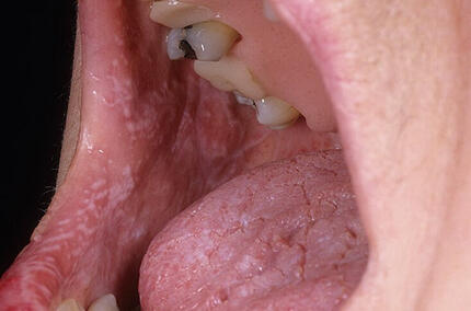 liszaj płaski jamy ustnej