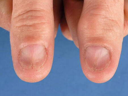 liszaj płaski paznokci