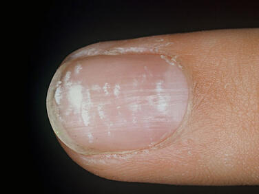 małe białe kropki na paznokciach
