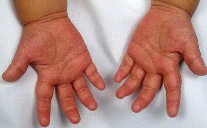 objawy pims ts podobne do choroby Kawasakiego wysypka na dłoniach