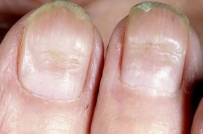 Podłużne bruzdy na paznokciach