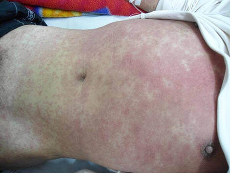 rumień zakaźny - objawy u dorosłych