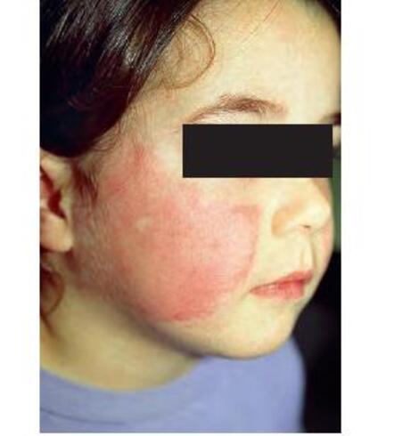 rumień zakaźny u dzieci