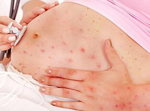 rumień zakaźny w ciąży