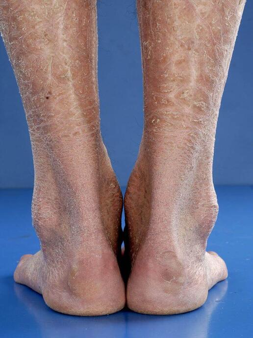 rybia łuska pospolita