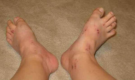 swędzenie skóry stóp w ciąży