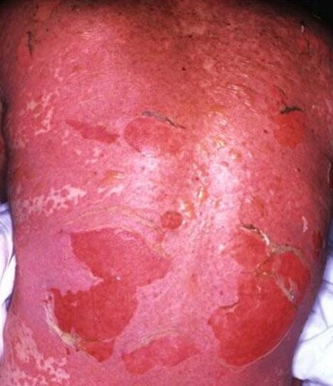 toksyczne martwicze oddzielanie się naskórka 