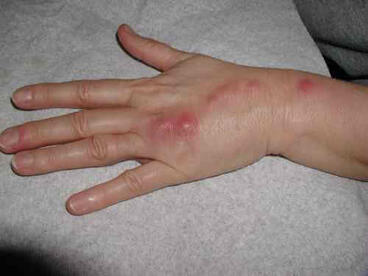 ukłucie kolcem róży choroba sporotrychoza