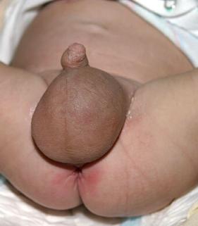 wodniak jądra u dziecka 