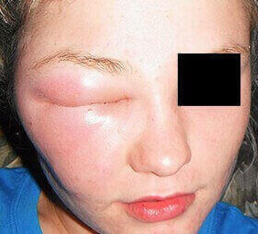 wstrząs anafilaktyczny po ukąszeniu pszczoły