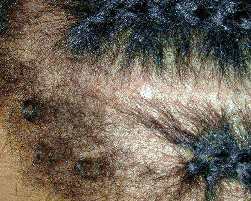 zapalenie mieszków włosowych na głowie