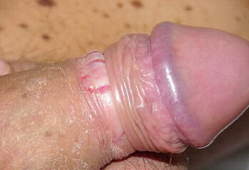 zapalenie napletka u dorosłego