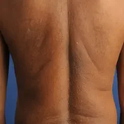 Guzki grudki na plecach ziarniniak obrączkowaty 