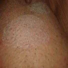 Łuszczyca łonowa u kobiet