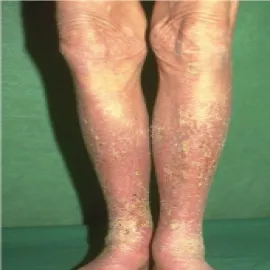  Łuszczące się plamy na nodze wyprysk podudzi