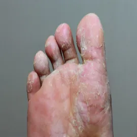 Łuszczenie skóry między palcami stopa sportowca 