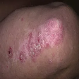 Łuszczyca na łokciu