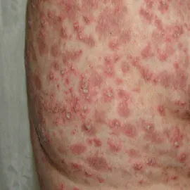 łuszczyca krostkowa