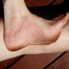 łuszczyca na stopach 