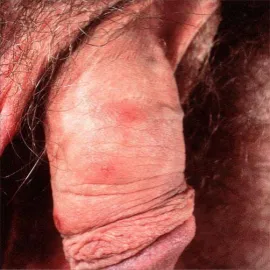 Świerzb guzkowy na penisie