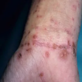 Świerzb na nadgarstku