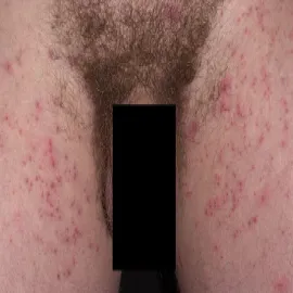 Świerzb okolic intymnych u mężczyzny