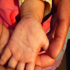 Świerzb u dziecka na dłoni