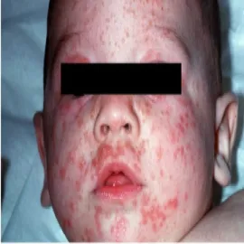 Świerzb u dziecka na twarzy