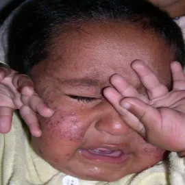 Świerzb u dziecka objawy