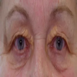 Żółta narośl na oku żółtaki 