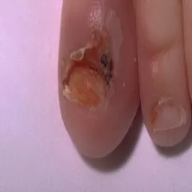 Acrodermatitis enteropathica zdjęcie