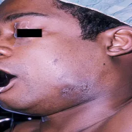 Aktynomikoza choroba