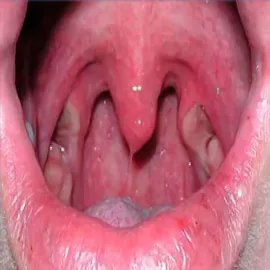 Angina Plauta-Vincenta 