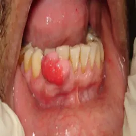 Bąbel na dziąśle nadziąślak 