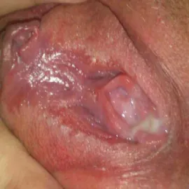 Biała wydzielina z pochwy 