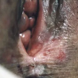 Białe zmiany na wargach sromowych leukoplakia sromu