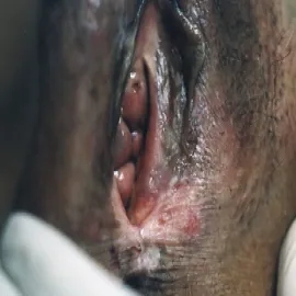 Biały nalot na wargach sromowych i swędzenie leukoplakia sromu